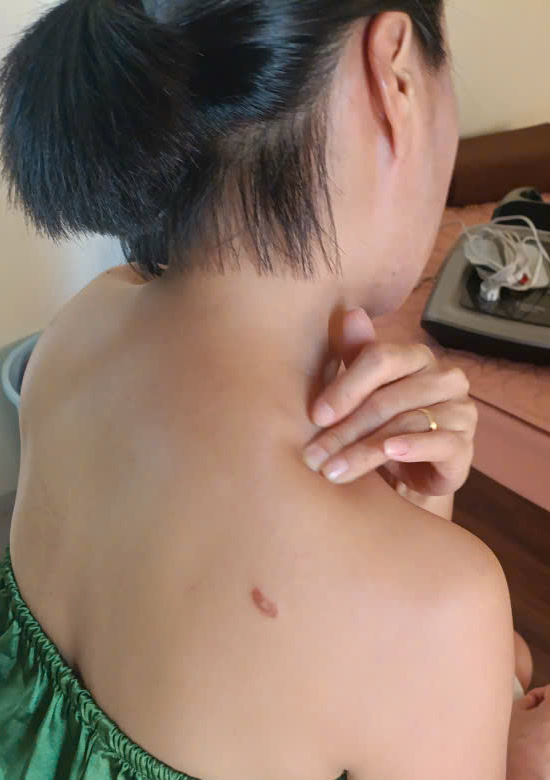 Bấm huyệt Kiên Tỉnh trên đỉnh vai giảm mỏi cổ vai gáy